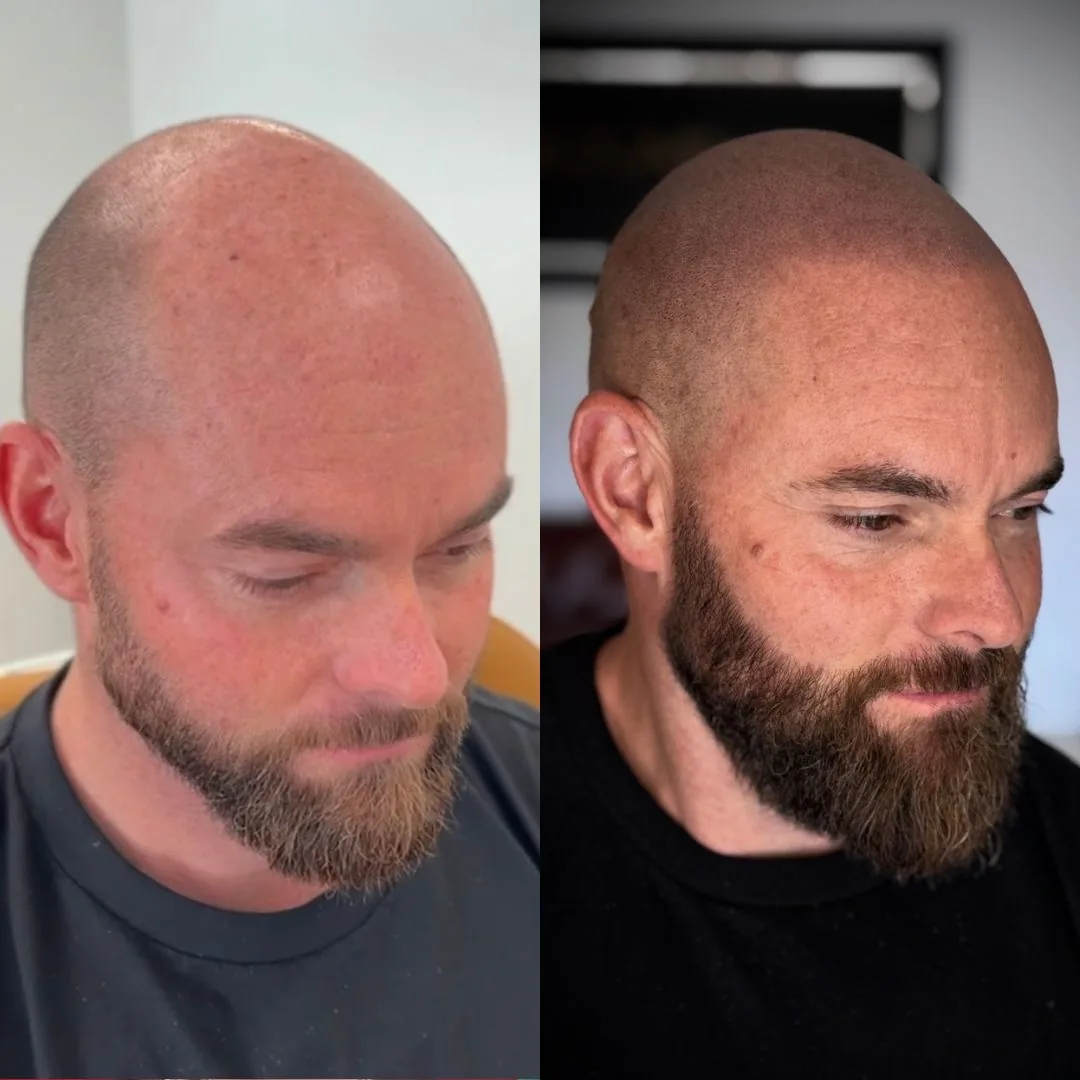 Before and after SMP