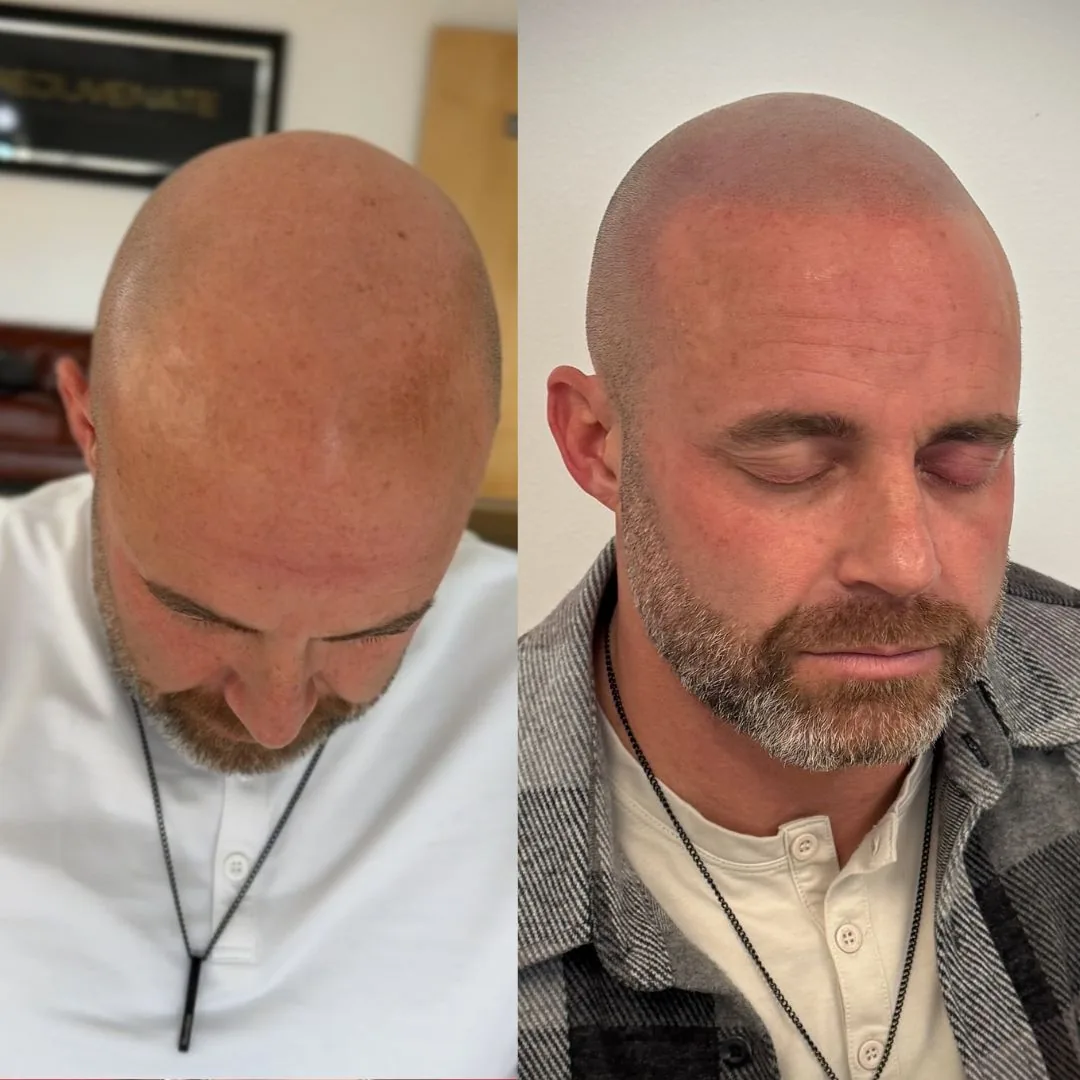 Before and after scar camouflage