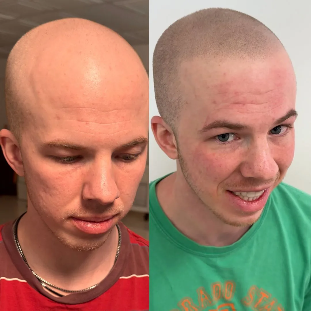 Before and after SMP