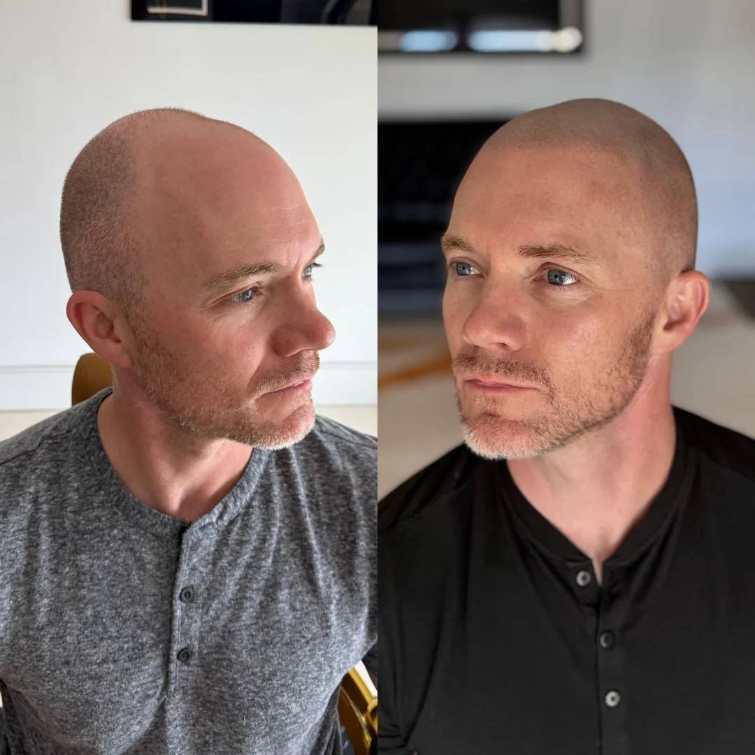 Before and after full scalp SMP