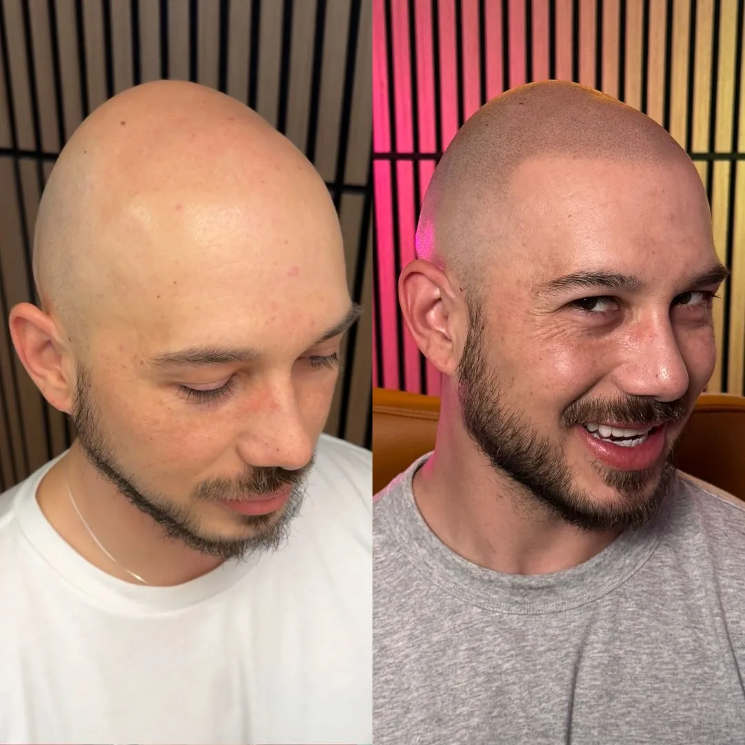 Before and after scalp micropigmentation by Huber Najera