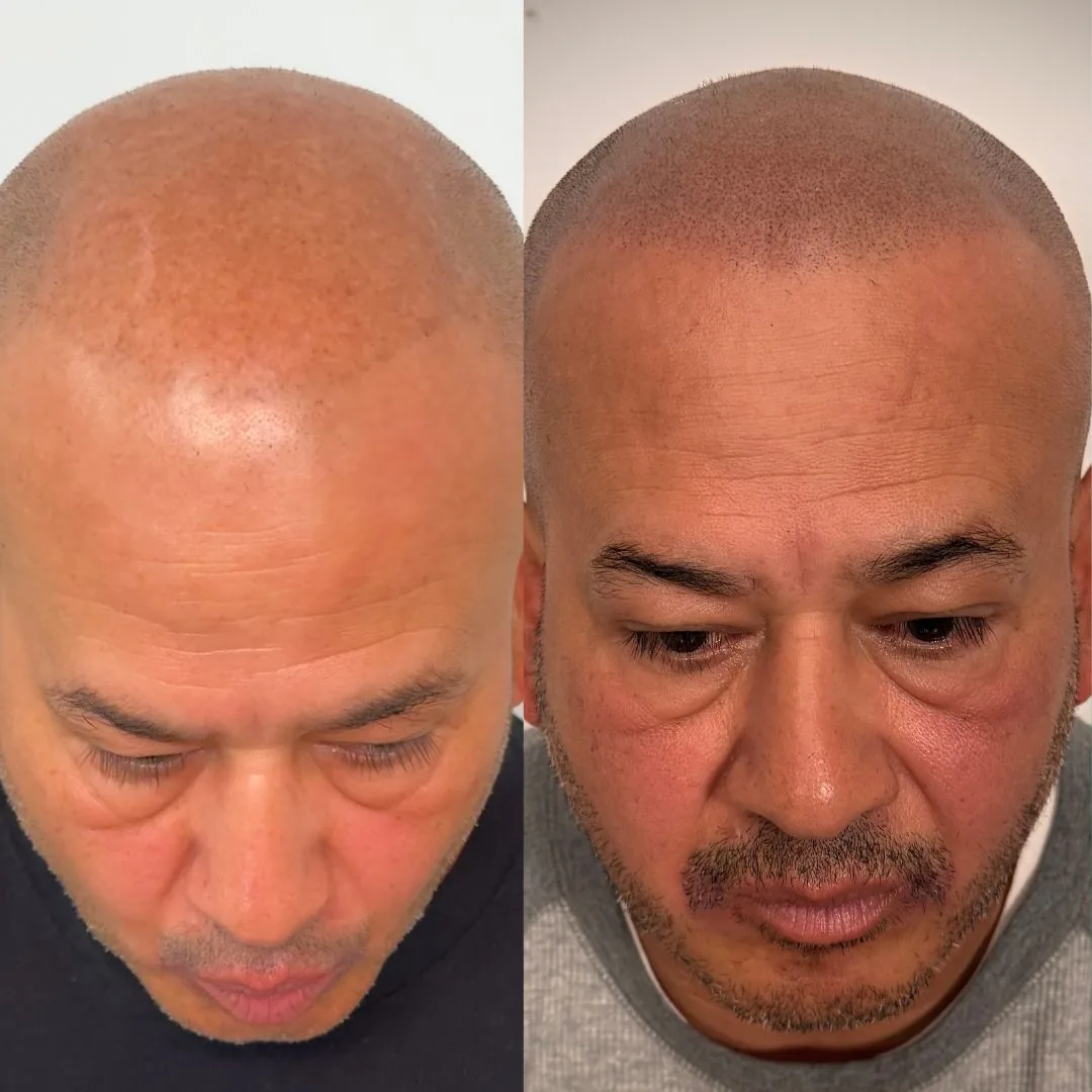 Before and after SMP