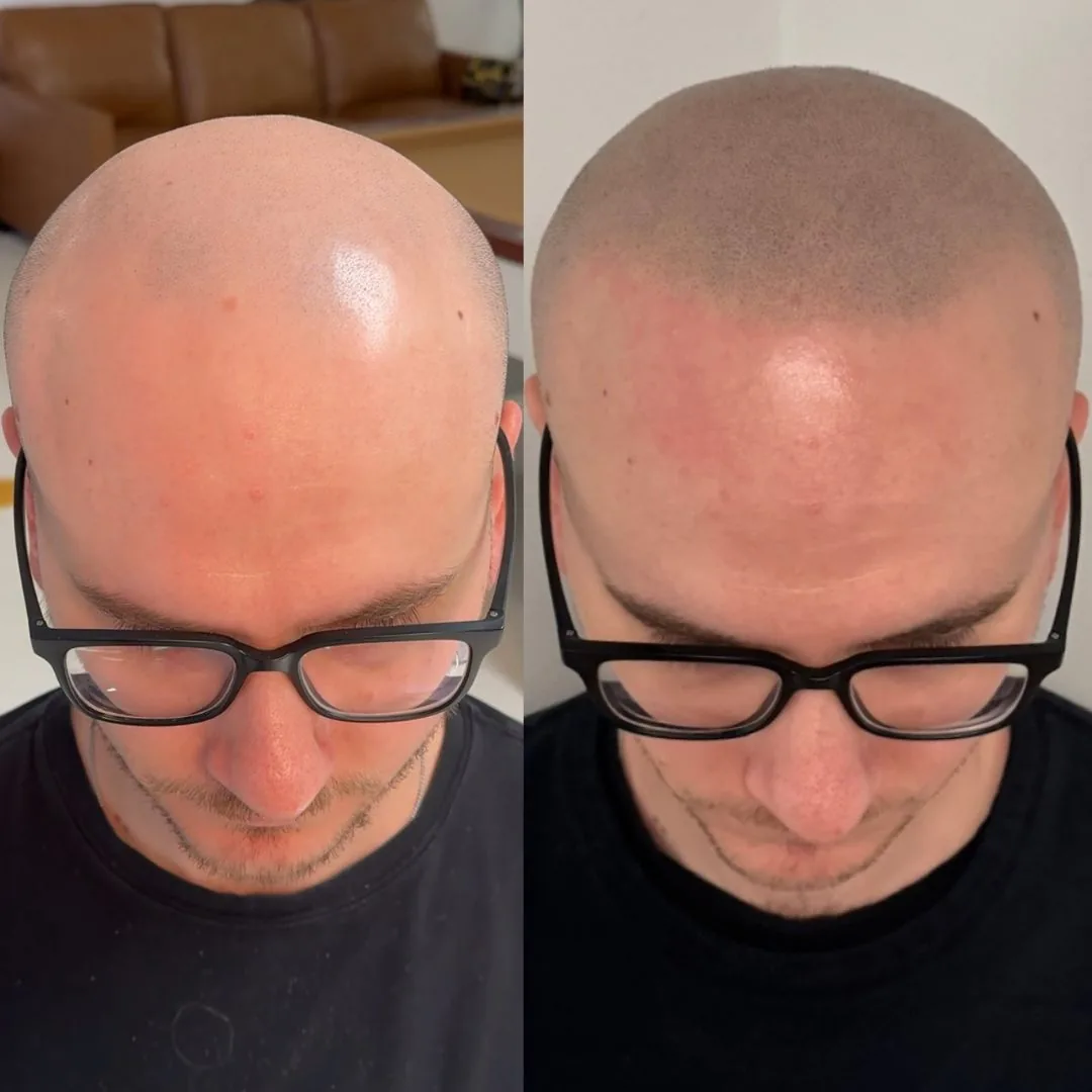 Before and after SMP density