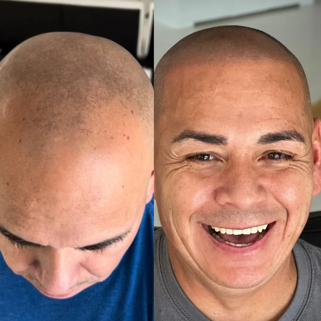 Before and after SMP